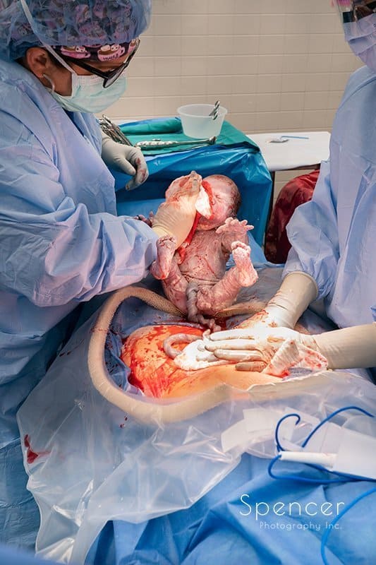 doctor cleaning newborn after being pulled from womb :: birth photography